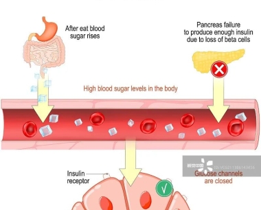 间充质干细胞在治疗1型糖尿病中的作用