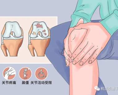 近年来干细胞疗法在治疗膝骨关节炎中的应用回顾