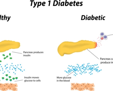 如何诊断我是否患有1型糖尿病？