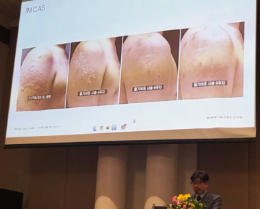 韩国Miracell在国际美容整形外科宣布用干细胞疗法治愈银屑病