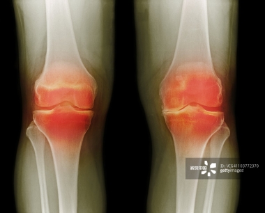 贵医附院 | 人脐带间充质干细胞治疗膝骨关节炎患者的1期临床试验
