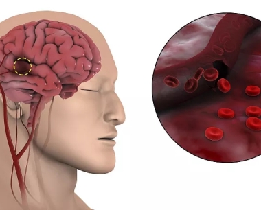 干细胞疗法：一种很有前途的脑出血治疗方法