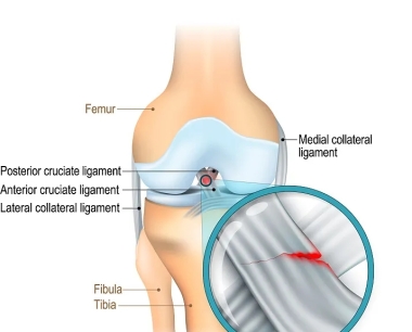 自体干细胞疗法用于半月板和前交叉韧带再生的案例