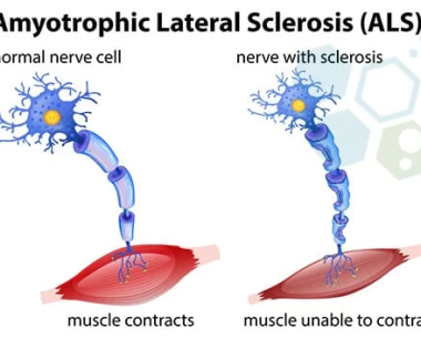 ALS的神经源性干细胞疗法 (MSC+Neural)