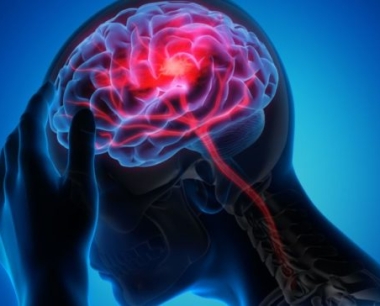 脑梗塞-原因、症状和治疗