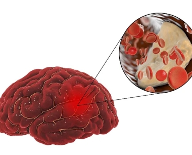 白细胞介素-6在神经干细胞移植在治疗中风中发挥的作用