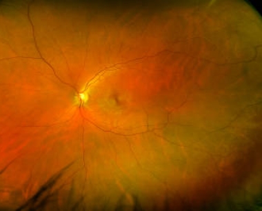 北大人民医院眼科研究所：干细胞治疗遗传性视网膜疾病研究看点