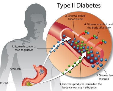 2型糖尿病的症状、原因、治疗