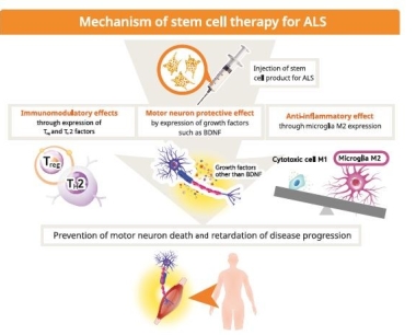 首个获得许可的ALS干细胞疗法