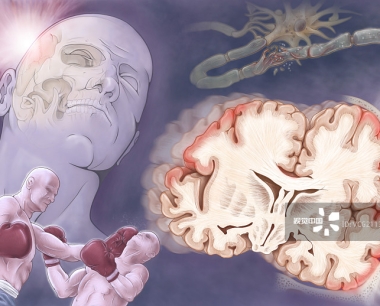 间充质干细胞治疗创伤性脑损伤的临床进展