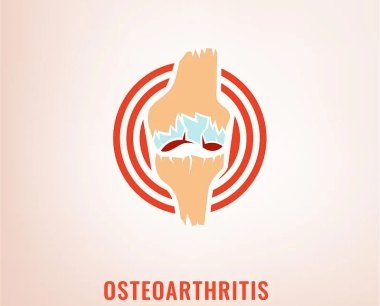 注射间充质干细胞可改善膝关节骨性关节炎的症状