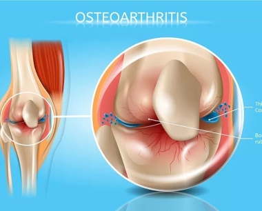 山东大学齐鲁医院：干细胞治疗膝骨性关节炎可改善膝关节功能并减轻疼痛