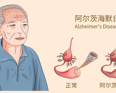 阿尔茨海默病有哪些症状丨如何诊断阿尔茨海默病？
