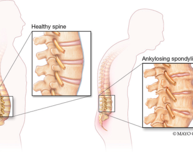 强直性脊柱炎的类型和阶段