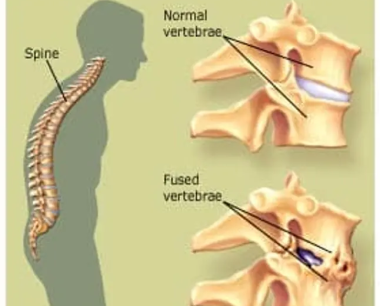 什么是强直性脊柱炎？