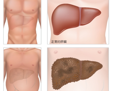 干细胞移植作为中国人群肝硬化的辅助治疗策略
