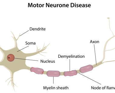 运动神经元病 (MND) – 原因、症状和治疗