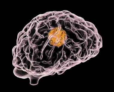 脑肿瘤——常见程度、症状、治疗和原因