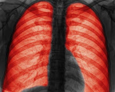 关于慢性阻塞性肺病的基础知识