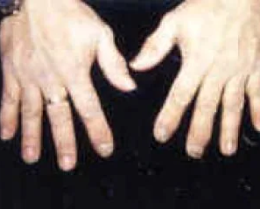 指甲银屑病的症状以及治疗