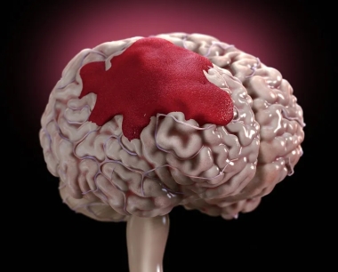 神经干细胞移植治疗脑出血，促进神经功能恢复