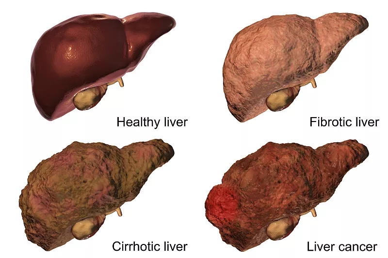 肝脏疾病的进展分期说明