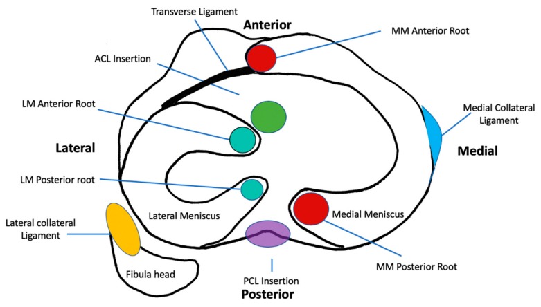 图1:胫骨平台水平的轴向截面示意图,描绘了半月板的解剖结构、附件和关系 图1:胫骨平台水平的轴向截面示意图,描绘了半月板的解剖结构、附件和关系