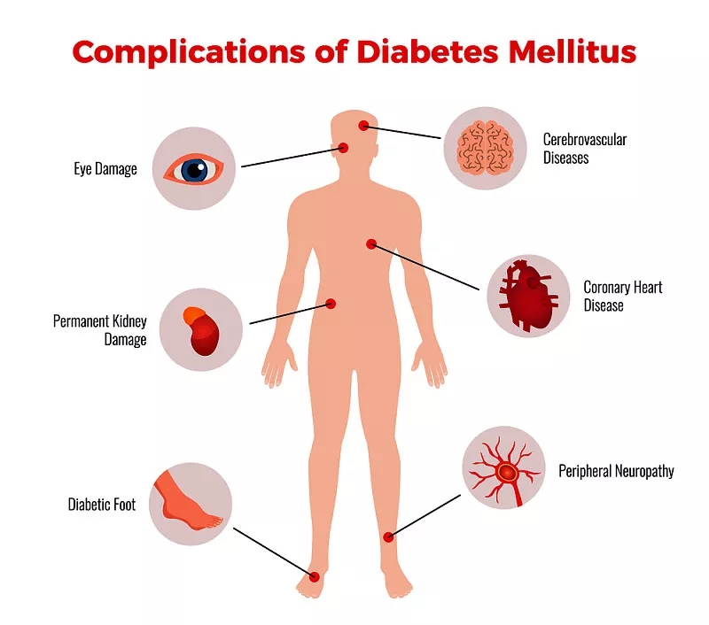 间充质干细胞在治疗糖尿病及并发症的临床应用潜力