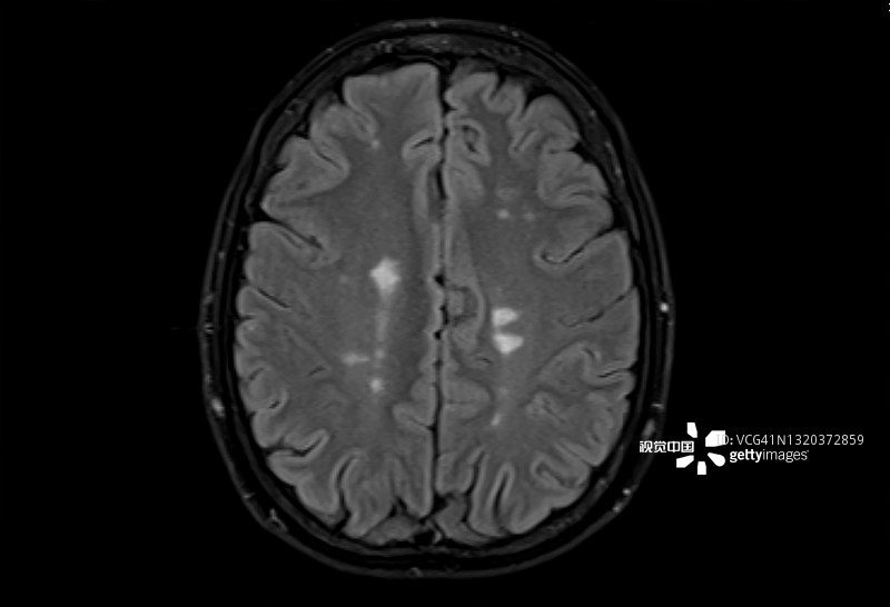 多发性脑硬化症的磁共振成像，轴位Flair视图
