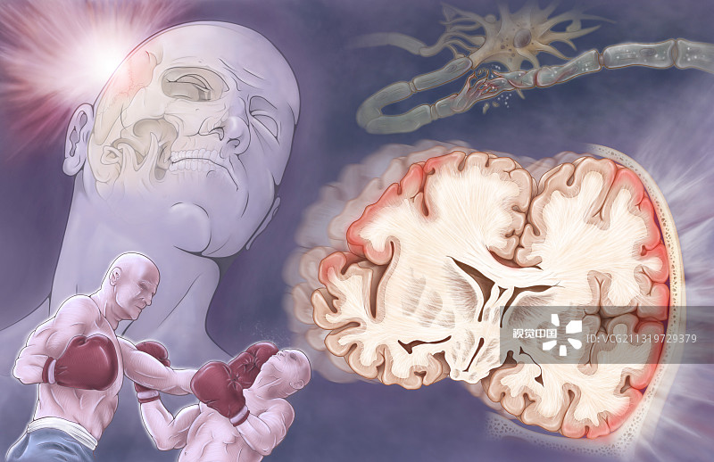 间充质干细胞治疗创伤性脑损伤的临床进展