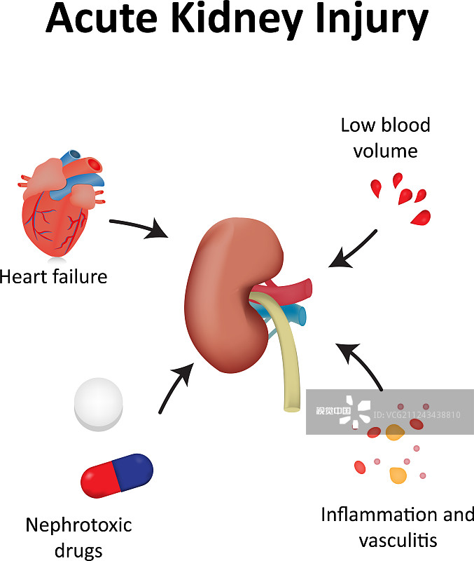 间充质干细胞治疗急性肾损伤的临床研究进展 间充质干细胞治疗急性肾损伤的临床研究进展