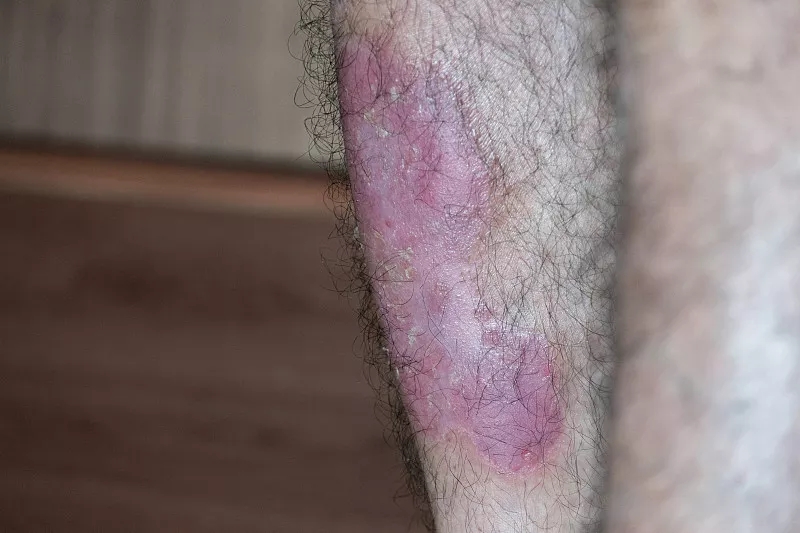 干细胞治疗银屑病