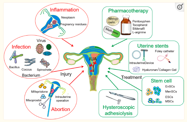 图1:子宫内膜损伤的机制及主要治疗策略。 图1:子宫内膜损伤的机制及主要治疗策略。