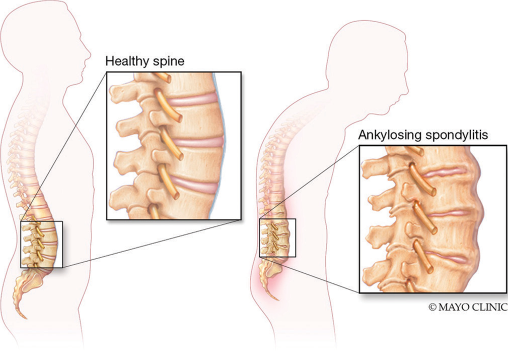 强直性脊柱炎的类型和阶段