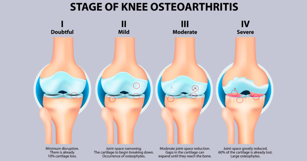 骨关节炎症状有哪些