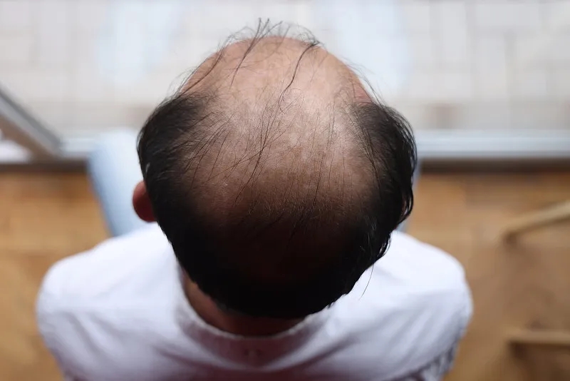 干细胞治疗脱发的优缺点