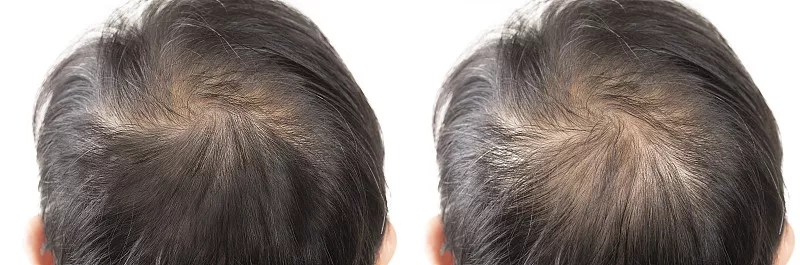 干细胞移植治疗脱发可能改变头发再生的未来