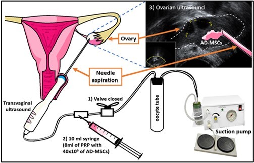 图1：PRP+AD-MSCs在卵巢中的应用；