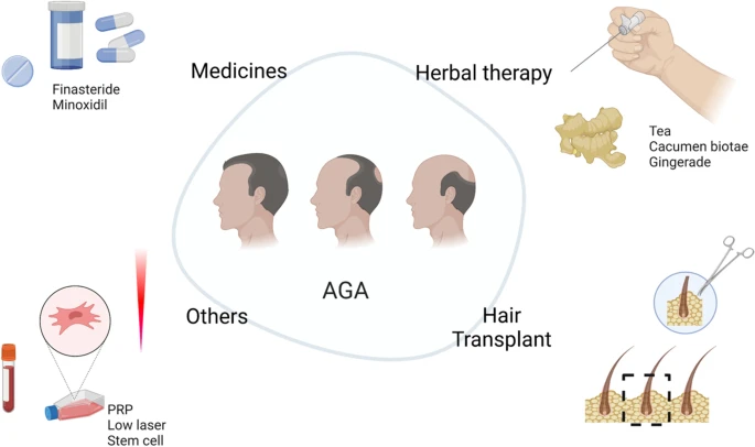 图1：雄激素性脱发的传统疗法