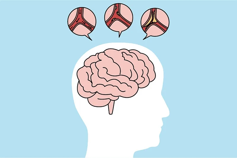 通过比较6、12、24个月的结果,来评估干细胞治疗缺血性中风的有效性和安全性 通过比较6、12、24个月的结果,来评估干细胞治疗缺血性中风的有效性和安全性