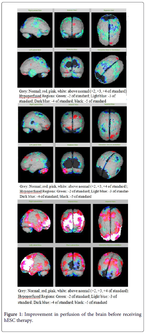 图1：接受hESC治疗前大脑灌注的改善。
