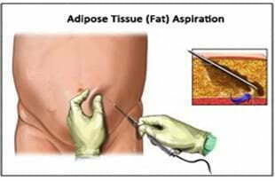 从脂肪中分离干细胞脂肪