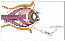 6. 细胞后小管输注