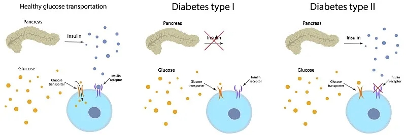干细胞可以治愈糖尿病吗？