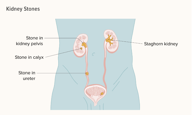 关于肾结石您需要知道的一切 关于肾结石您需要知道的一切