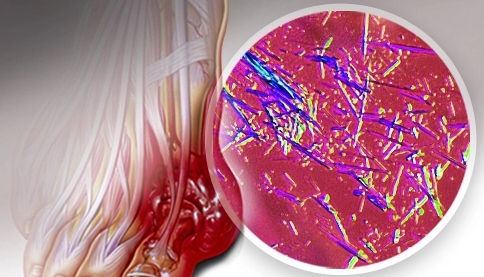 干细胞治疗：间充质干细胞能显著改善痛风性关节炎！