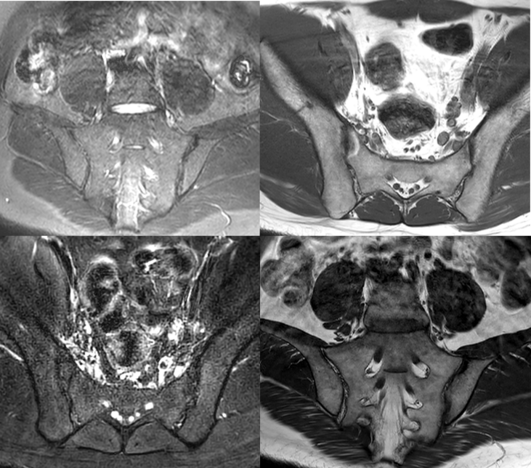 强直性脊柱炎是遗传病吗？