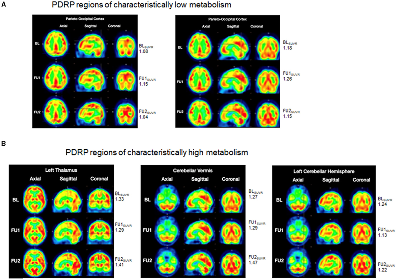 图3：FDG-PET扫描