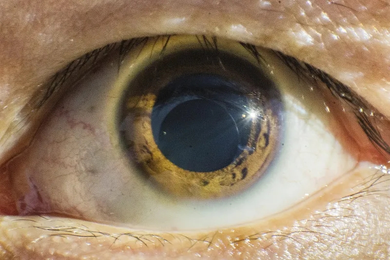 间充质干细胞治疗青光眼的治疗潜力