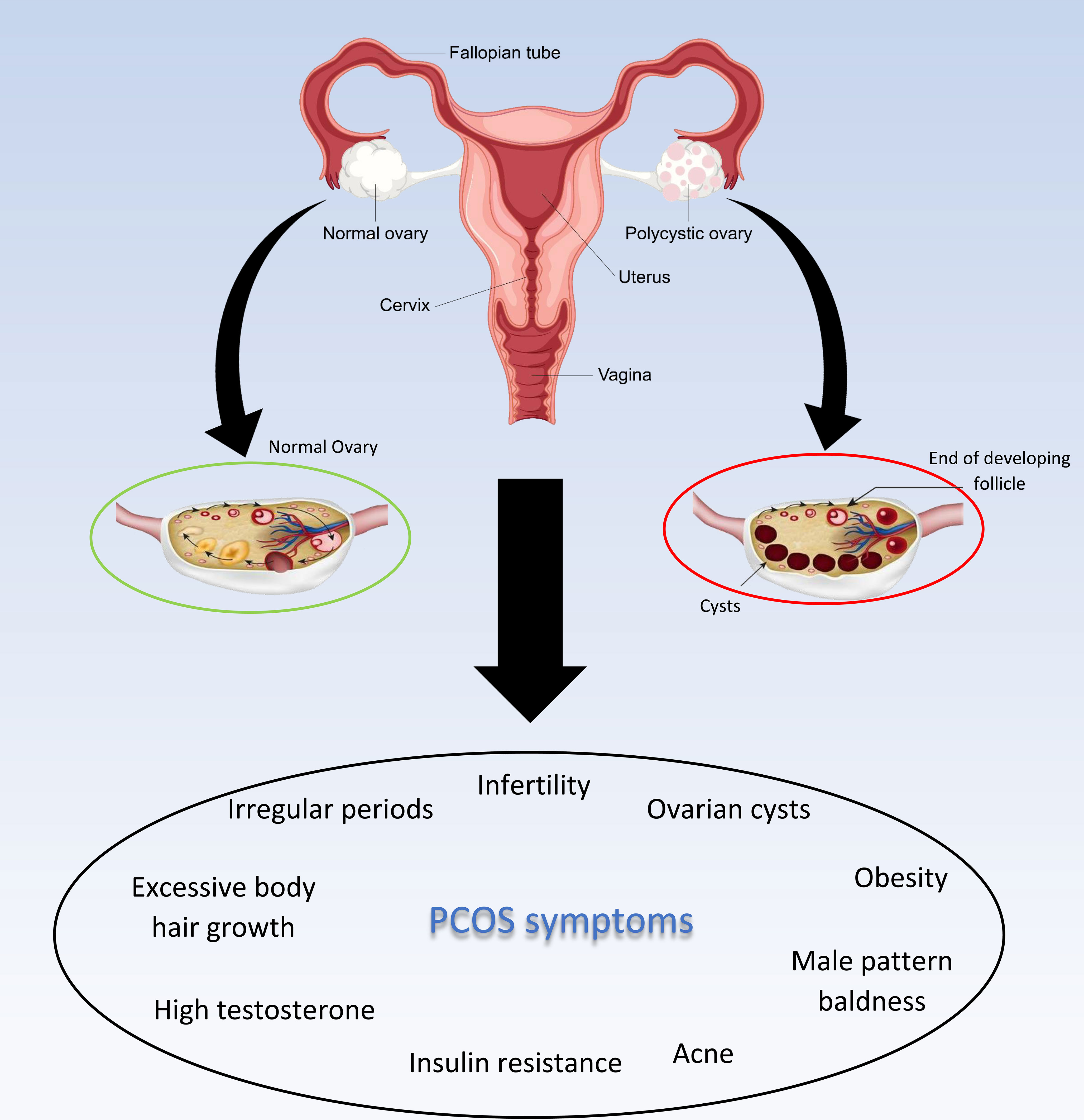 图2:多囊卵巢综合症及其症状 图2:多囊卵巢综合症及其症状